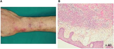 Immunemodulatory Effects of 5-Azacitidin Through Expansion of Functional Regulatory T Cells on Paraneoplastic Inflammation Associated With Myelodysplastic Syndromes: A Case Report